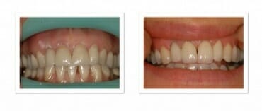porcelain crowns for the upper jaw porcelain crowns