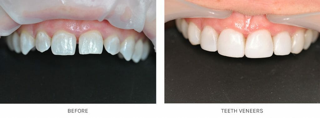 beautiful before and after photos of teeth veneers Teeth Veneers