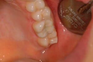 same-filling-by-andrew same white filling by The Art of Dentistry