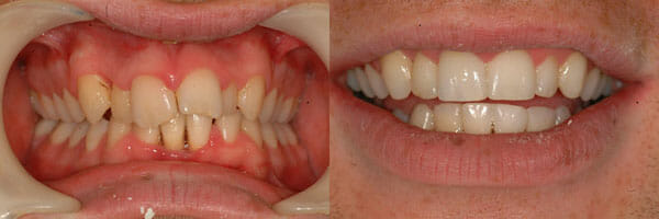 Before and after treatment with Inman Aligners, Example 1