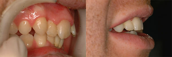 Before and after treatment with Inman Aligners, Example 2