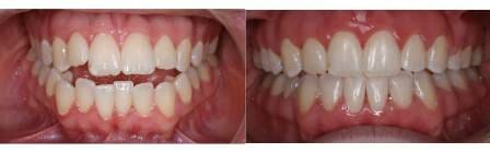 Damon before and after examples