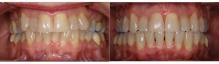 Before and after treatment with the Damon System