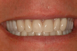 DSCF0030 after treatment