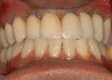 Implant Bridges Implant Bridges