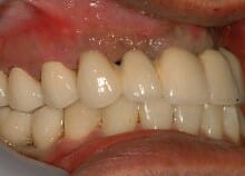 Implant Bridges Implant Bridges