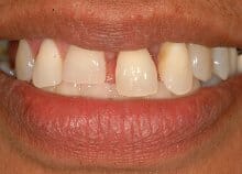 Titanium Acrylic Bridge Full Upper Arch Titanium Acrylic Bridge Full Upper Arch