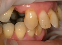 Full Upper Implant Bridge Full Upper Implant Bridge