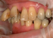 Full Upper Implant Bridge Full Upper Implant Bridge