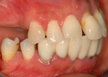 Titanium Acrylic Bridge Full Upper Arch Titanium Acrylic Bridge Full Upper Arch