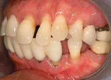 Titanium Acrylic Bridge Full Upper Arch Titanium Acrylic Bridge Full Upper Arch