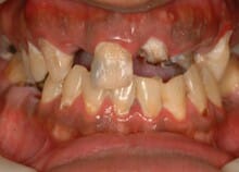 Implant Bridges Implant Bridges