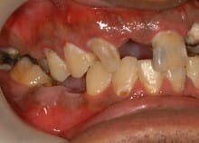 Implant Bridges Implant Bridges