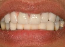 Titanium Acrylic Bridge Full Upper Arch Titanium Acrylic Bridge Full Upper Arch