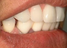 Titanium Acrylic Bridge Full Upper Arch Titanium Acrylic Bridge Full Upper Arch