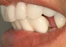 Titanium Acrylic Bridge Full Upper Arch Titanium Acrylic Bridge Full Upper Arch