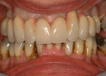 Full Upper Implant Bridge Full Upper Implant Bridge