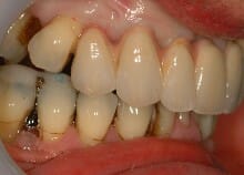 Full Upper Implant Bridge Full Upper Implant Bridge
