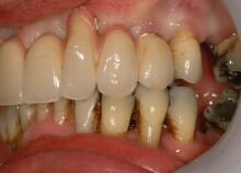 Full Upper Implant Bridge Full Upper Implant Bridge