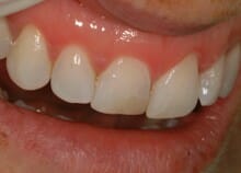 Immediate Veneers - Single Upper Incisor Immediate Veneers - Single Upper Incisor