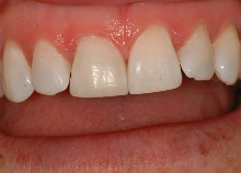 Immediate Veneers - Single Upper Incisor Immediate Veneers - Single Upper Incisor
