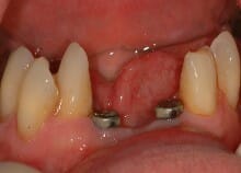 Implant Bridge Replacing Lower Incisors Implant Bridge Replacing Lower Incisors