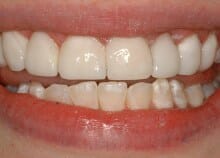 Immediate Veneers - Upper Front Teeth Immediate Veneers - Upper Front Teeth
