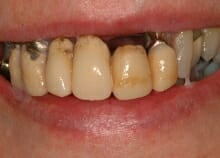 Implant Retained Dentures Implant Retained Dentures