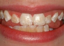 Immediate Veneers - Upper Front Teeth Immediate Veneers - Upper Front Teeth