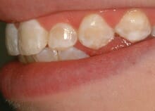 Immediate Veneers - Upper Front Teeth Immediate Veneers - Upper Front Teeth