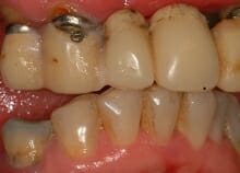 Implant Retained Dentures Implant Retained Dentures