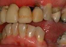 Implant Retained Dentures Implant Retained Dentures