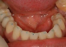 Implant Bridges Implant Bridges