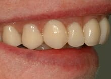 Implant Retained Dentures Implant Retained Dentures