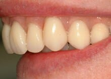 Implant Retained Dentures Implant Retained Dentures