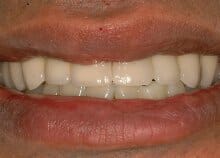 Implant Bridges Implant Bridges