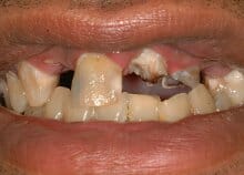 Implant Bridges Implant Bridges