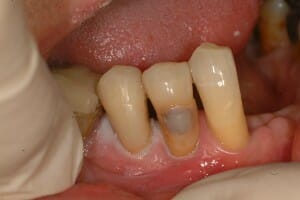 2 teeth with italian fillings, the one in the middle not done yet White fillings