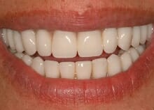 Upper and Lower Implant retained dentures Upper and Lower Implant retained dentures
