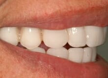 Upper and Lower Implant retained dentures Upper and Lower Implant retained dentures