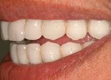 Upper and Lower Implant retained dentures Upper and Lower Implant retained dentures
