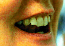 Before RHS Inman Aligner