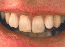 Before ant Inman Aligner