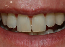 after ant 3 Inman Aligner