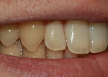Straightening Teeth without Visible Braces after 2 Straightening Teeth without Visible Braces after 2