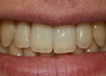 Straightening Teeth without Visible Braces after Straightening Teeth without Visible Braces after