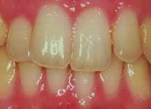 Straightening Teeth without Visible Braces Straightening Teeth without Visible Braces