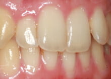 Straightening Teeth without Visible Braces before Straightening Teeth without Visible Braces before