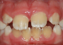 early orthodontics - teeth straightening for children in essex early orthodontics - teeth straightening for children in essex