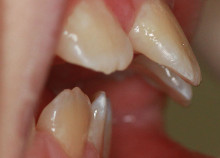 early orthodontics - teeth straightening for children in essex before early orthodontics - teeth straightening for children in essex before